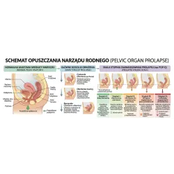 Obniżenie narządu rodnego - problem, który wymaga zrozumienia