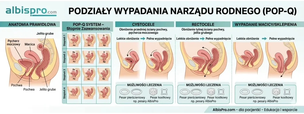 Wypadania narządu rodnego, podział na stopnie w zależności od zaawansowania - prosty przewodnik dla kobiet Wypadania narządu rodnego, podział na stopnie w zależności od zaawansowania - prosty przewodnik dla kobiet