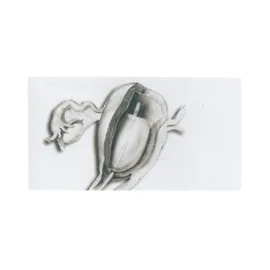 Balon hemostatyczny poporodowy typ Bakri