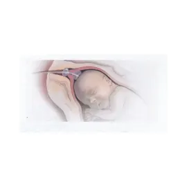 Cewnik dwubalonowy do indukcji porodu