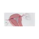 Stent maciczny trójkątny 5ml balon przeciwkrwotoczny tamponada po histeroskopii / G0504 / ALBIS