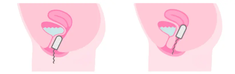 Tampon podpierający zastosowanie na nietrzymanie moczu